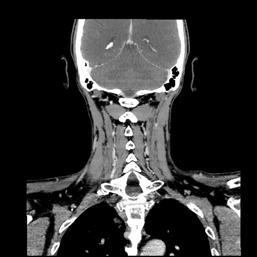 Anaplastic thyroid carcinoma (Radiopaedia 79087-92034 A 87).jpg