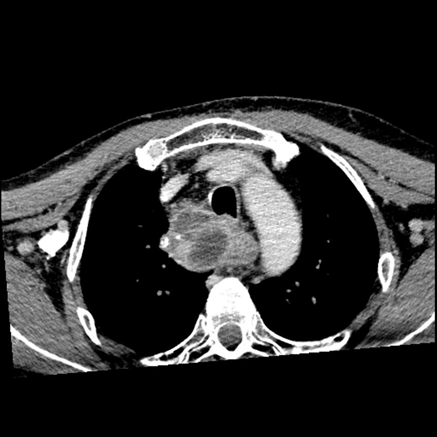 Anaplastic thyroid carcinoma (Radiopaedia 79087-92034 B 12).jpg
