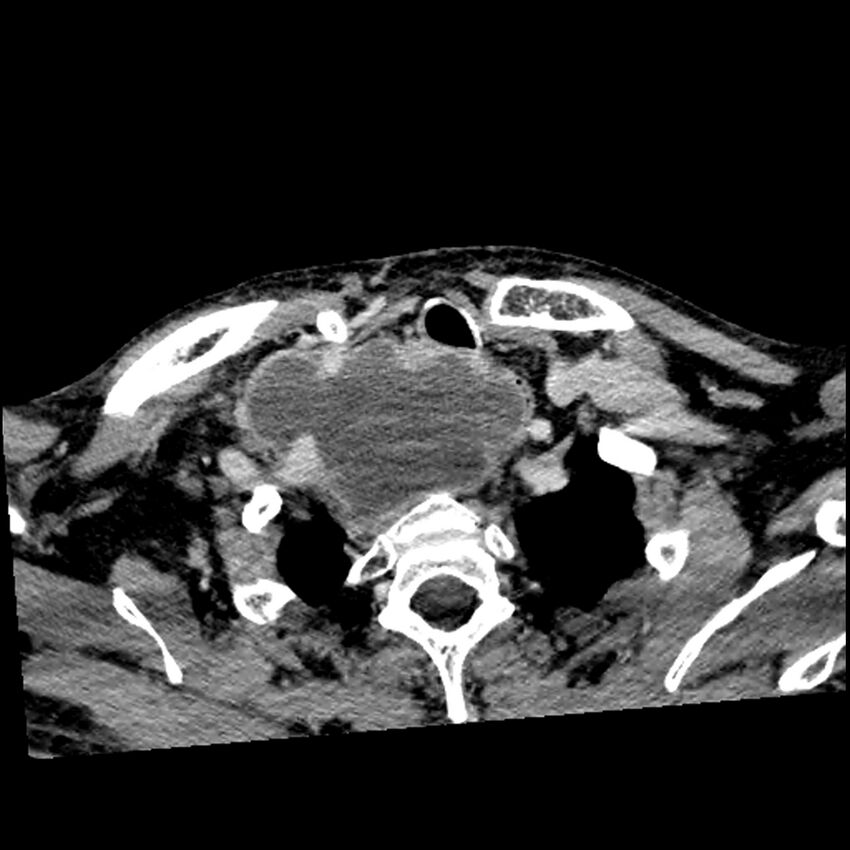Anaplastic thyroid carcinoma (Radiopaedia 79087-92034 B 32).jpg
