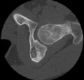 Aneurysmal bone cyst of ischium (Radiopaedia 25957-26094 B 19).png