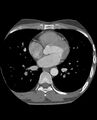 Anomalous coronary arteries (Radiopaedia 83979-99206 A 166).jpg