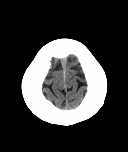 File:Anomalous intracranial venous drainage (Radiopaedia 28161-28418 Axial 56).png