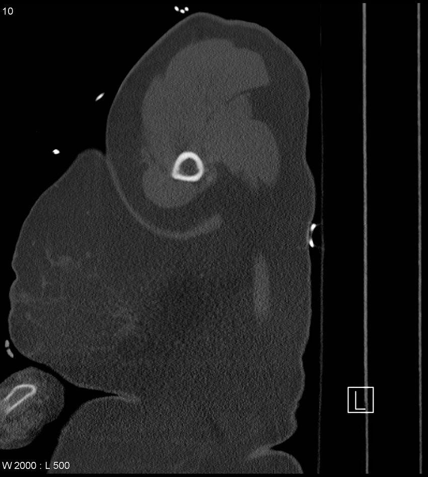 Anterior shoulder dislocation (CT) (Radiopaedia 59032-66309 Sagittal bone window 5).jpg