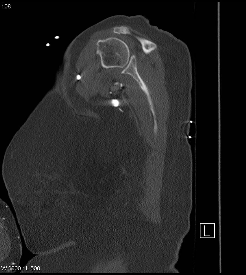 Anterior shoulder dislocation (CT) (Radiopaedia 59032-66309 Sagittal bone window 54).jpg