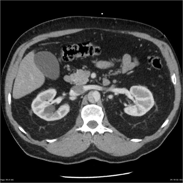 File:Aortic dissection- Stanford A (Radiopaedia 37759-39664 A 89).jpg