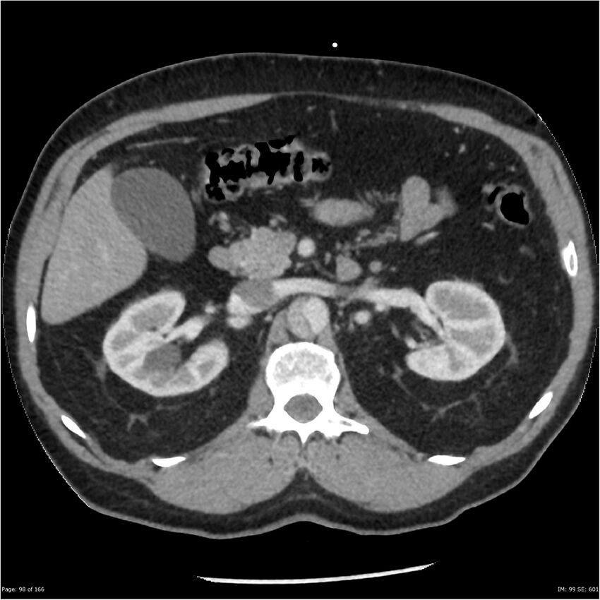Aortic dissection- Stanford A (Radiopaedia 37759-39664 A 89).jpg