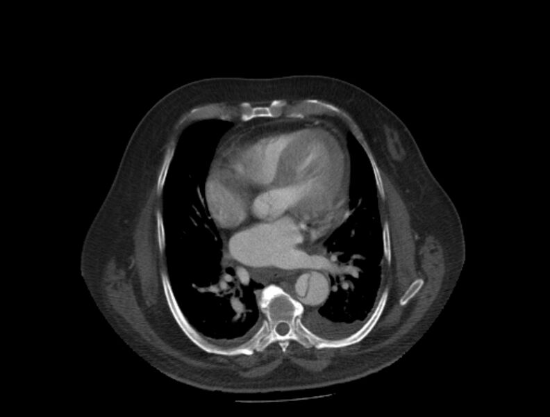 File:Aortic dissection (Radiopaedia 28802-29105 A 23).jpg