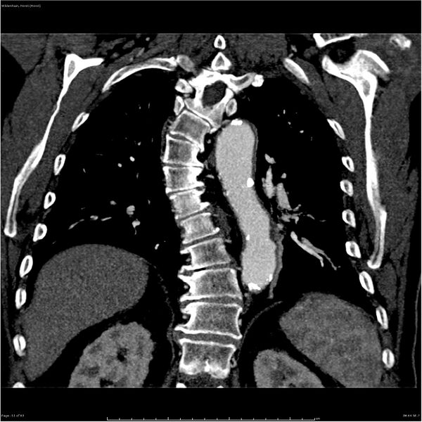 File:Aortic dissection - Stanford type A (Radiopaedia 26183-26315 A 51).jpg
