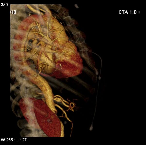 File:Aortic dissection with rupture into pericardium (Radiopaedia 12384-12647 C+ arterial phase 12).jpg