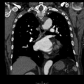 Aorto-coronary bypass graft aneurysms (Radiopaedia 40562-43157 B 28).png