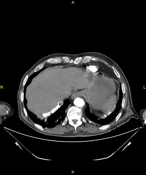 File:Aortoenteric fistula (Radiopaedia 84308-99603 B 27).jpg