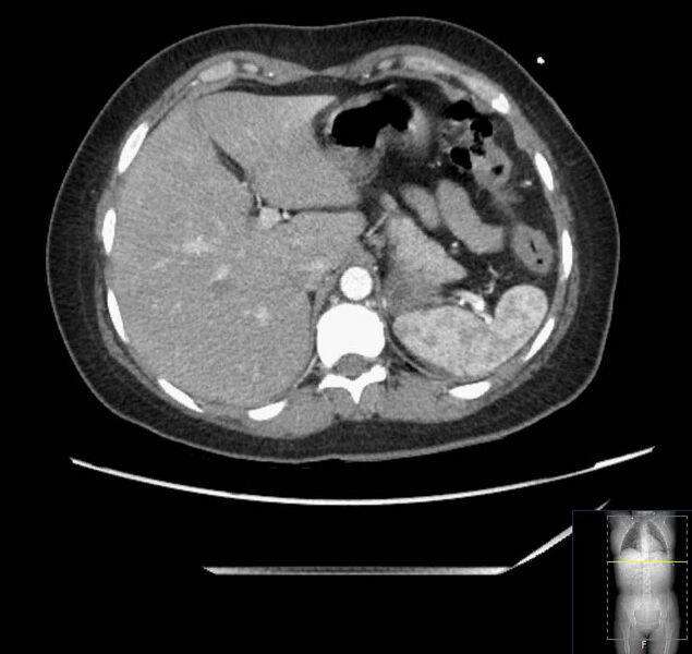 File:Appendicitis (CT angiogram) (Radiopaedia 154713-127660 Axial 157).jpg