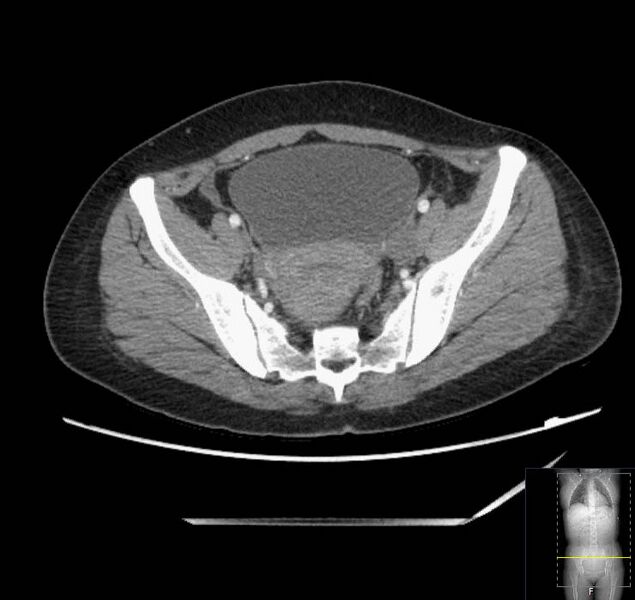 File:Appendicitis (CT angiogram) (Radiopaedia 154713-127660 Axial 16).jpg