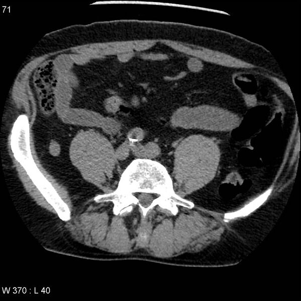 File:Appendicitis (Radiopaedia 12510-12733 Axial non-contrast 31).jpg