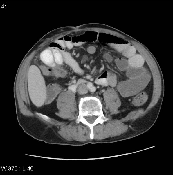 File:Appendicitis (Radiopaedia 27446-27642 A 20).jpg