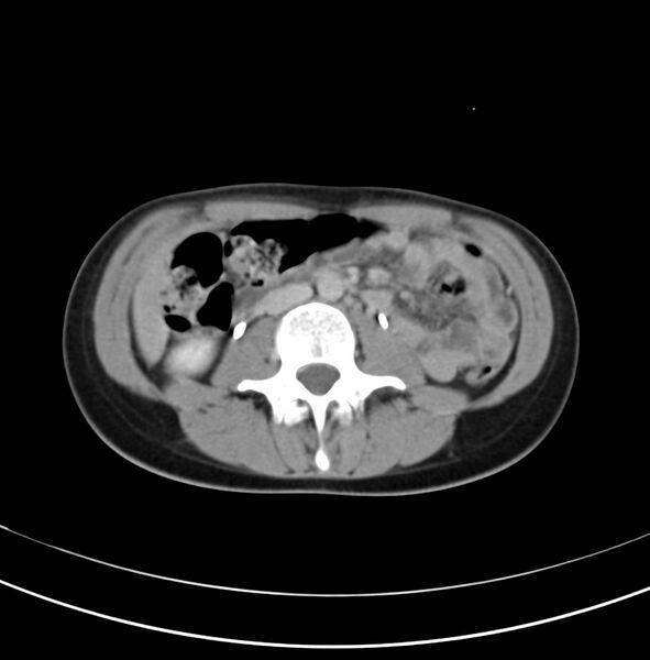 File:Appendicitis and incidental bicornuate uterus (Radiopaedia 22833-22853 Axial C+ delayed 16).jpg