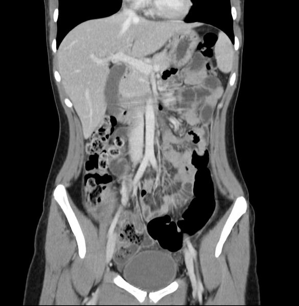File:Appendicitis and incidental bicornuate uterus (Radiopaedia 22833-22853 D 15).jpg