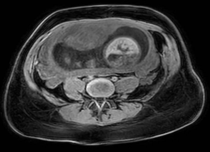 Appendicitis in gravida (MRI) (Radiopaedia 89433-106395 Axial DIXON 92).jpg