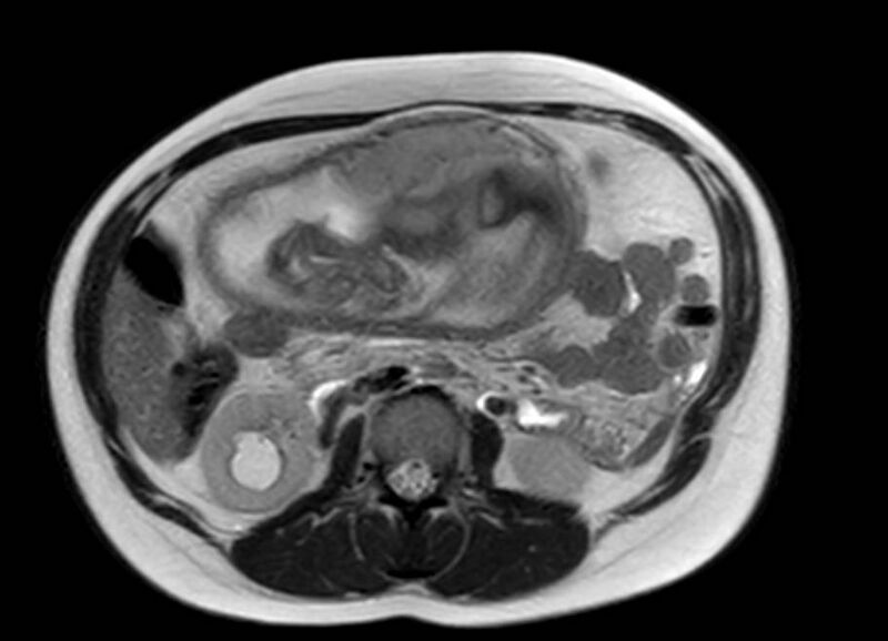 File:Appendicitis in gravida (MRI) (Radiopaedia 89433-106395 Axial T2 29).jpg