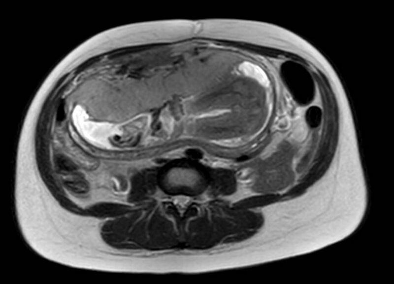 File:Appendicitis in gravida (MRI) (Radiopaedia 89433-106395 Axial T2 37).jpg