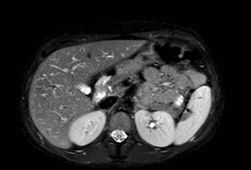 File:Appendicitis in gravida (MRI) (Radiopaedia 89433-106395 Axial T2 SPAIR 22).jpg