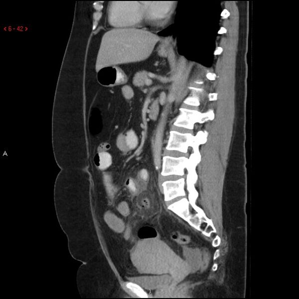 File:Appendicitis with microperforation- promontoric type (Radiopaedia 27268-27442 A 27).jpg