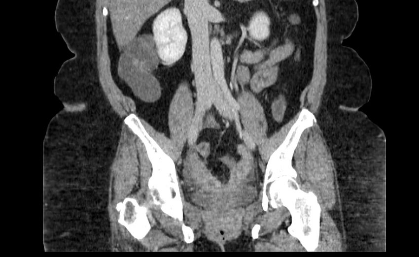 Appendix mucocele (Radiopaedia 41222-44033 B 49).jpg