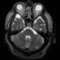 Arachnoid cyst - middle cranial fossa (Radiopaedia 9016-9775 Axial T2 1).jpg
