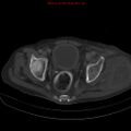 Arachnoiditis ossificans (Radiopaedia 51394-57136 Axial bone window 40).jpg