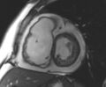 Arrhythmogenic right ventricular cardiomyopathy (Radiopaedia 69431-79307 Short axis cine 155).jpg