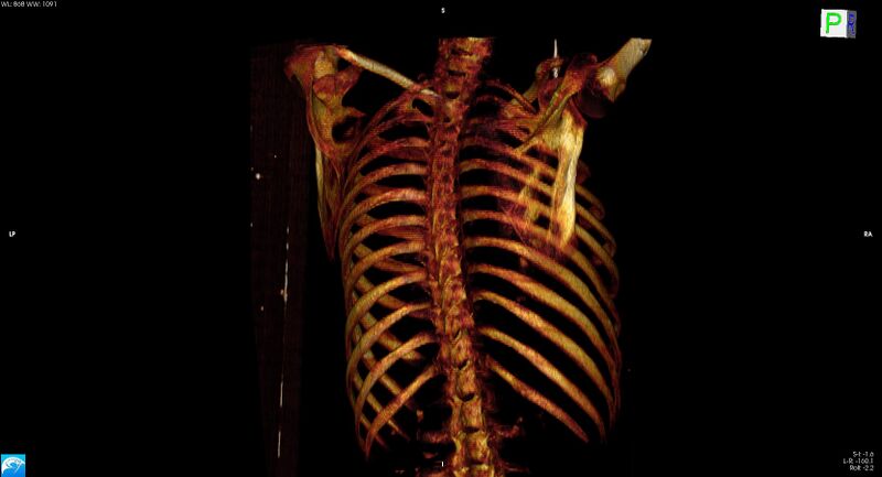 File:Arrow injury to the neck (Radiopaedia 75225-86323 3D bone 24).jpg