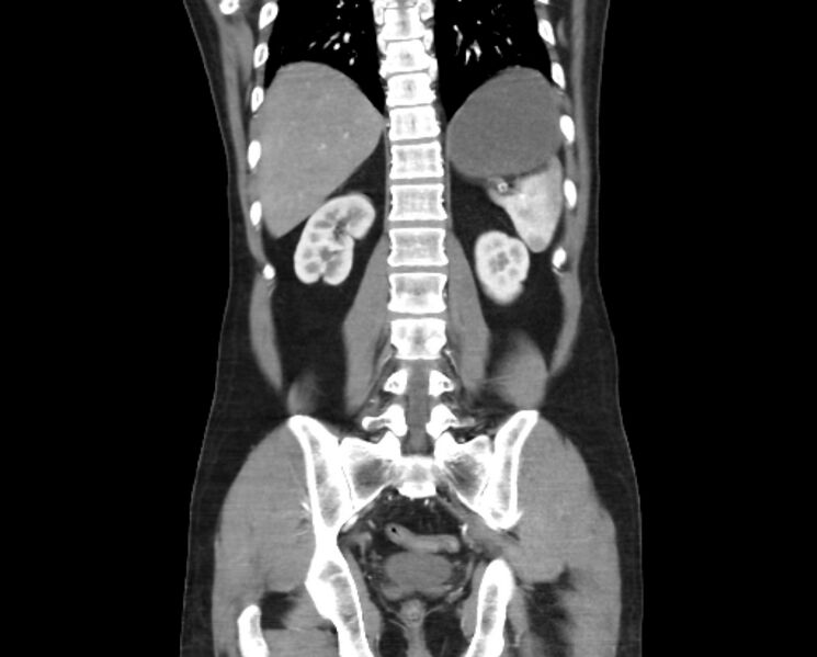 File:Arterial occlusive mesenteric ischemia (Radiopaedia 84641-100060 B 41).jpg