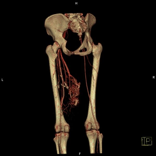 File:Arteriovenous malformation of the thigh (Radiopaedia 14948-14883 C 8).jpg
