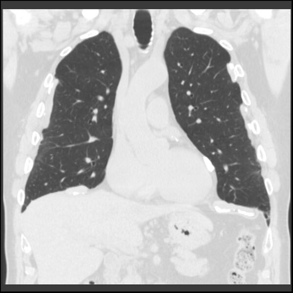 File:Asbestos-related pleural plaques (Radiopaedia 39069-41255 Coronal lung window 55).jpg