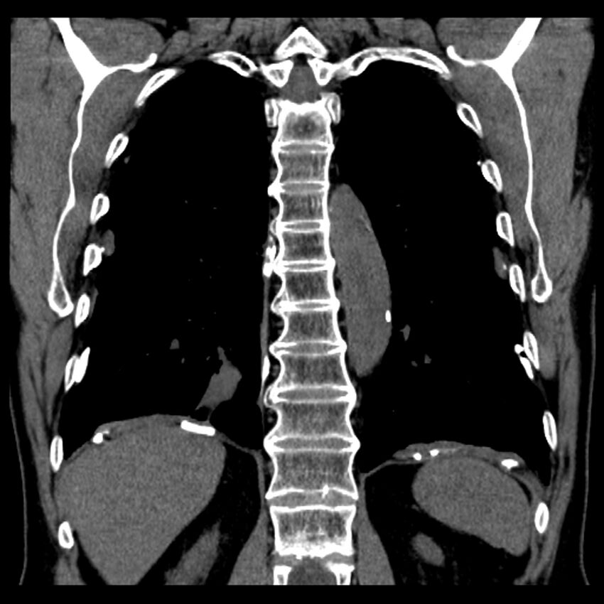 Asbestos-related pleural plaques (Radiopaedia 39069-41255 Coronal non-contrast 23).jpg