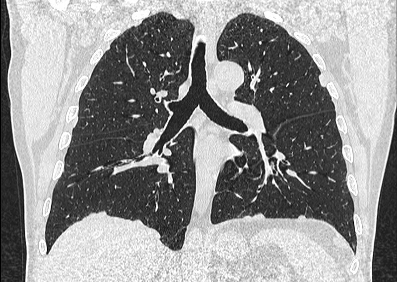 File:Asbestos pleural placques (Radiopaedia 57905-64872 Coronal lung window 164).jpg