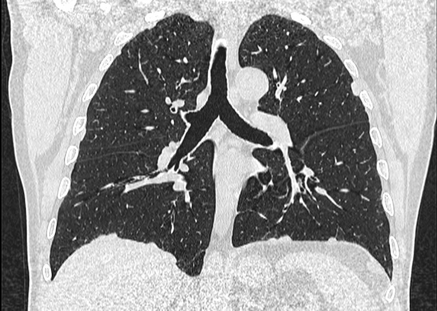 Asbestos pleural placques (Radiopaedia 57905-64872 Coronal lung window 164).jpg