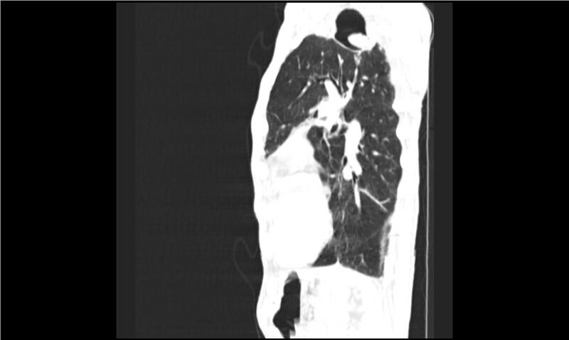 File:Aspergilloma (Radiopaedia 20788-20701 Sagittal lung window 5).jpg