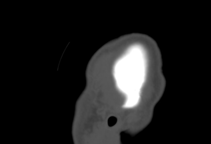 Asymptomatic occipital spur (Radiopaedia 87753-104201 Sagittal bone window 311).jpg