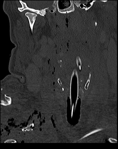 File:Atlanto-occipital dissociation - Traynelis type 1 (Radiopaedia 87570-103948 Coronal bone window 20).jpg