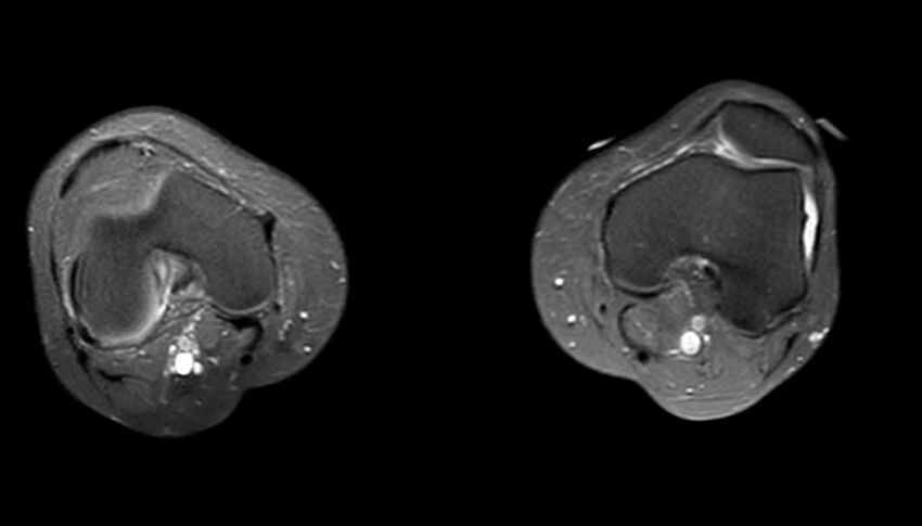 Atypical lipomatous tumor - thigh (Radiopaedia 68975-78734 Axial PD fat sat 9).jpg
