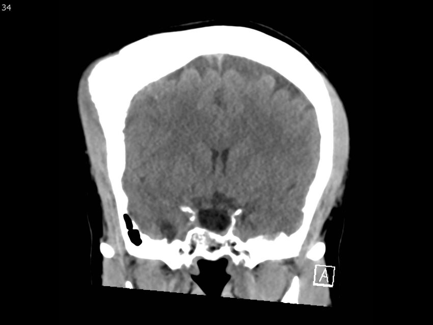 Atypical meningioma - intraosseous (Radiopaedia 64915-73867 B 33).jpg
