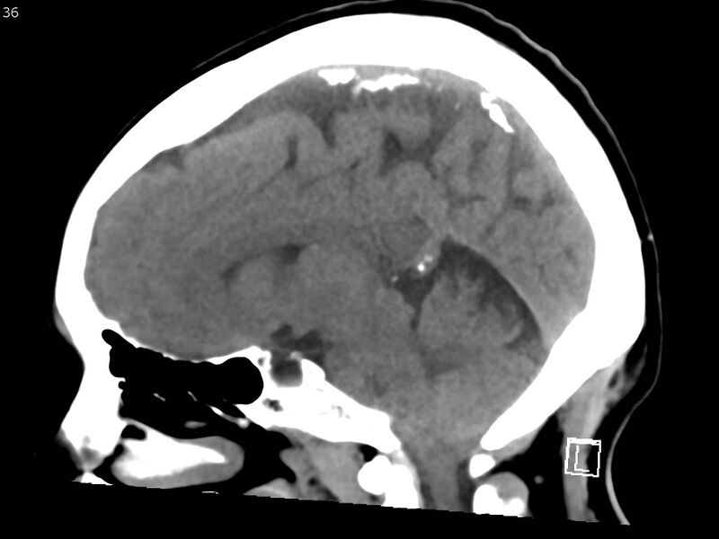 File:Atypical meningioma - intraosseous (Radiopaedia 64915-73867 C 34).jpg