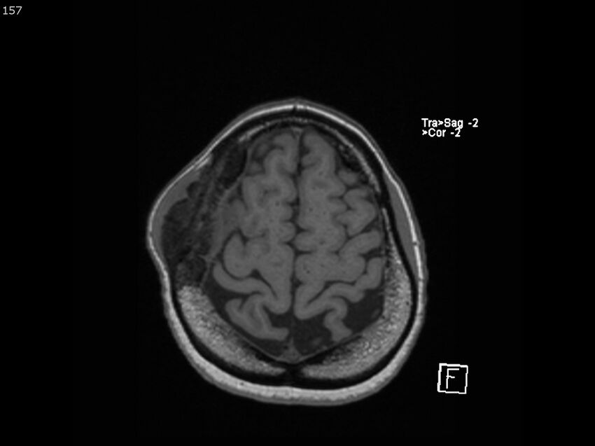 Atypical meningioma - intraosseous (Radiopaedia 64915-74572 Axial T1 157).jpg