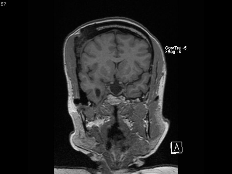 File:Atypical meningioma - intraosseous (Radiopaedia 64915-74572 Coronal T1 87).jpg