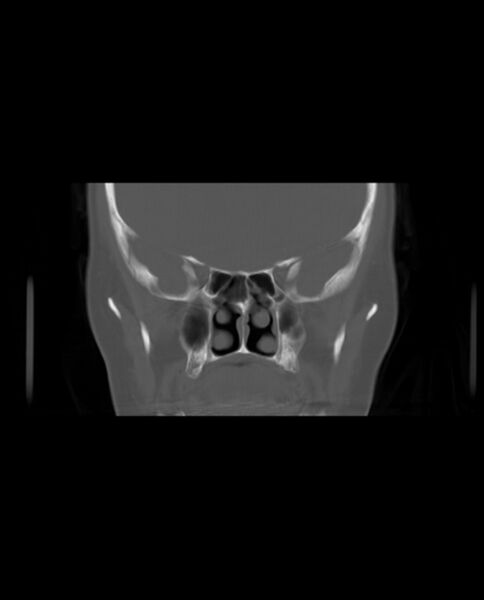 File:Automastoidectomy with labyrinthine fistula (Radiopaedia 84143-99411 Coronal non-contrast 50).jpg