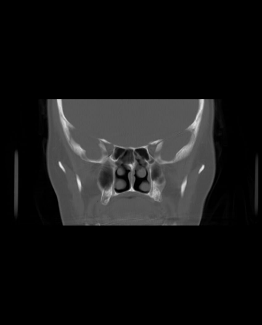 Automastoidectomy with labyrinthine fistula (Radiopaedia 84143-99411 Coronal non-contrast 50).jpg
