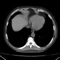 Autosomal dominant polycystic kidney disease (Radiopaedia 36539-38101 Axial non-contrast 6).jpg