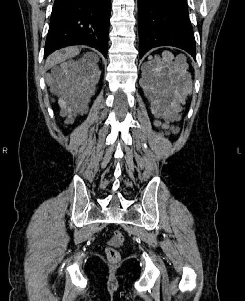File:Autosomal dominant polycystic kidney disease (Radiopaedia 87830-104287 Coronal non-contrast 52).jpg