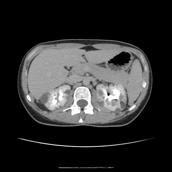 File:Autosomal dominant polycystic kidney disease - early onset (Radiopaedia 40734-43387 D 4).jpg